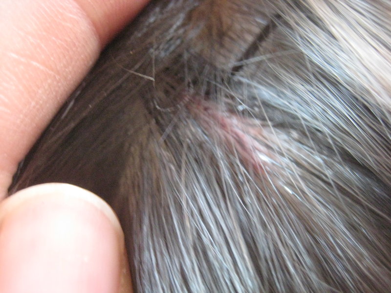 Mo falls off couch, splits head open (1cm laceration) all stitched up!